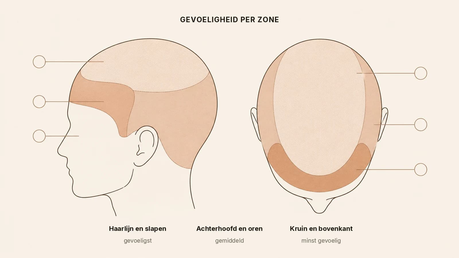 Kaart van de hoofdhuid met de gevoeligste zones tijdens een behandeling