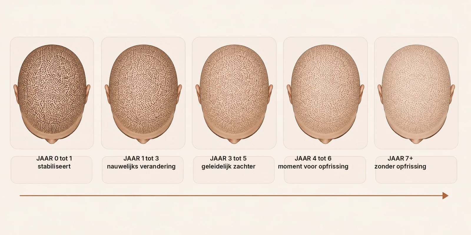 Hoe pigment van micro haarpigmentatie vervaagt over zes jaar