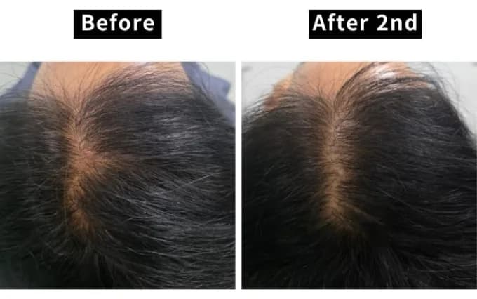 V Hair Rx — How FGF-9, FGF-5s and Noggin Work on the Hair Cycle