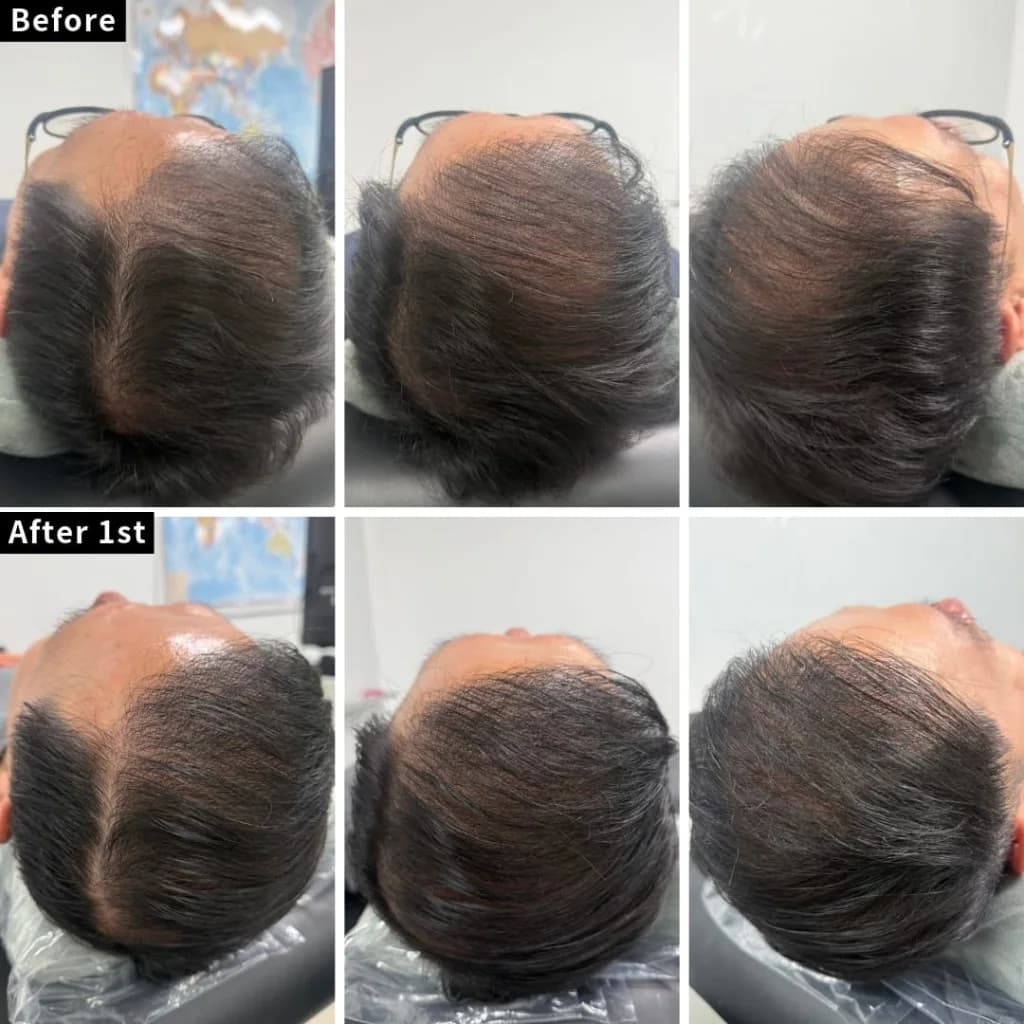 Top-down photos of a male scalp from three angles, before treatment and after the first session