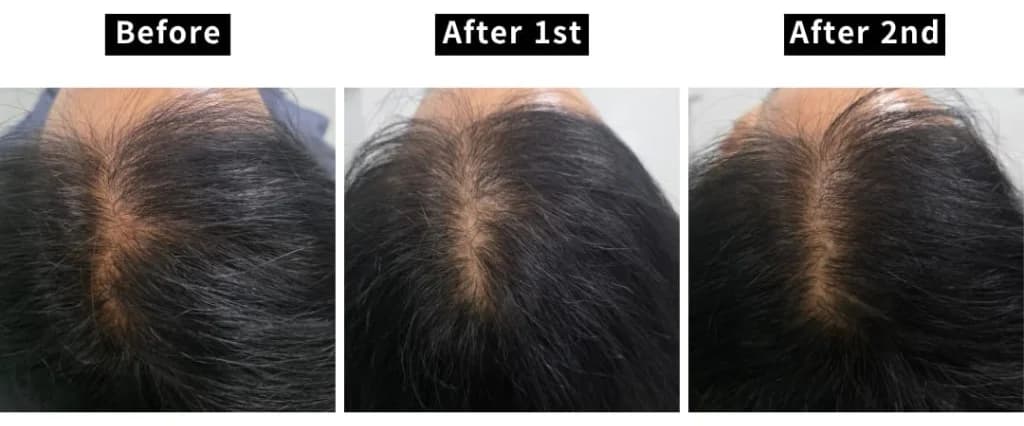 Top-down photos of a central part line before treatment, after the first session and after the second session