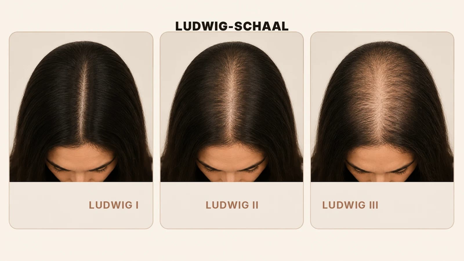 De Ludwig-schaal met drie stadia van vrouwelijk haarverlies