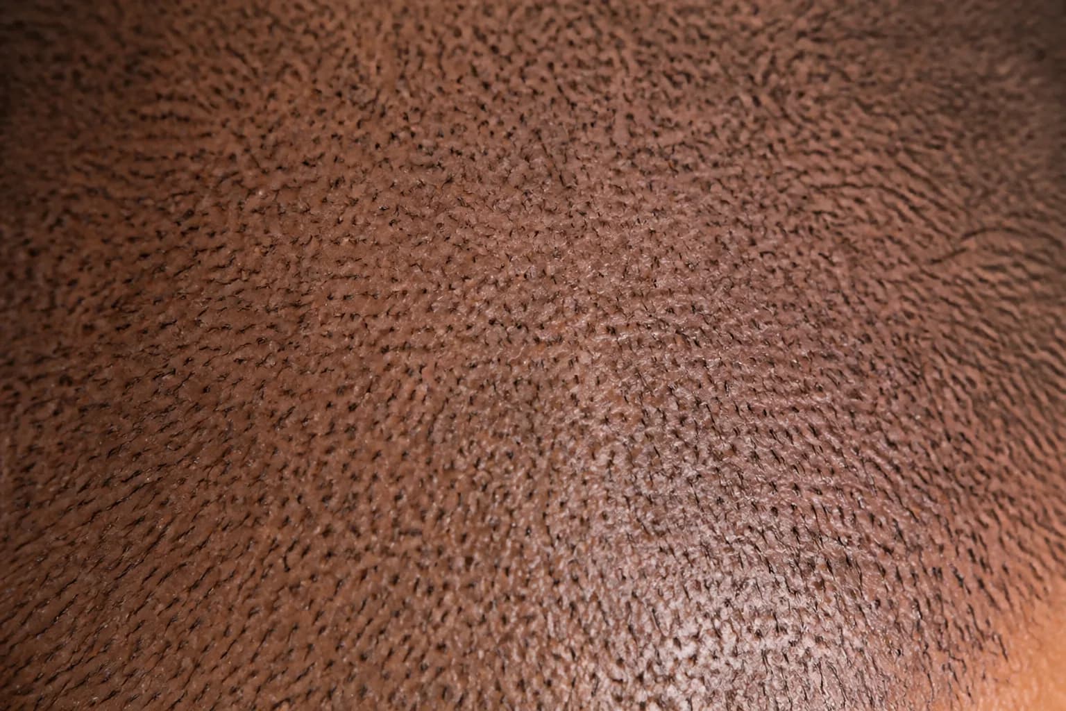 Close-up of scalp micropigmentation pigment dots recreating natural hair follicles
